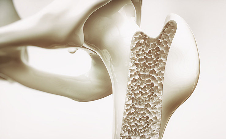 imagem 3D de um osso com osteoporose